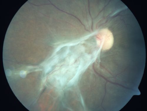 Preretinal Fibrosis - Tractional Retinal Detachment - Proliferative Diabetic Retinopathy 
33-year-old woman has proliferative diabetic retinopathy in the left eye with fibrosis and tractional retinal detachment.  Her vision is hazy in that eye.  VISUAL ACUITY:  Vision OD is 20/30, OS 20/120
