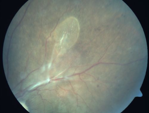 Preretinal Fibrosis - Tractional Retinal Detachment - Proliferative Diabetic Retinopathy 
33-year-old woman has proliferative diabetic retinopathy in the left eye with fibrosis and tractional retinal detachment.  Her vision is hazy in that eye.  VISUAL ACUITY:  Vision OD is 20/30, OS 20/120
