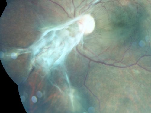 Preretinal Fibrosis - Tractional Retinal Detachment - Proliferative Diabetic Retinopathy 
33-year-old woman has proliferative diabetic retinopathy in the left eye with fibrosis and tractional retinal detachment.  Her vision is hazy in that eye.  VISUAL ACUITY:  Vision OD is 20/30, OS 20/120

