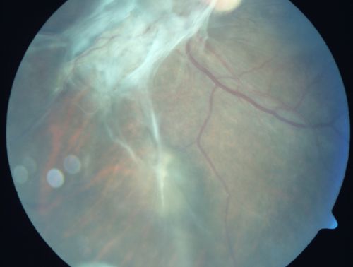 Preretinal Fibrosis - Tractional Retinal Detachment - Proliferative Diabetic Retinopathy 
33-year-old woman has proliferative diabetic retinopathy in the left eye with fibrosis and tractional retinal detachment.  Her vision is hazy in that eye.  VISUAL ACUITY:  Vision OD is 20/30, OS 20/120
