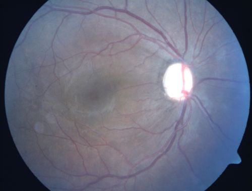 Preretinal Fibrosis - Tractional Retinal Detachment - Proliferative Diabetic Retinopathy 
33-year-old woman has proliferative diabetic retinopathy in the left eye with fibrosis and tractional retinal detachment.  Her vision is hazy in that eye.  VISUAL ACUITY:  Vision OD is 20/30, OS 20/120
