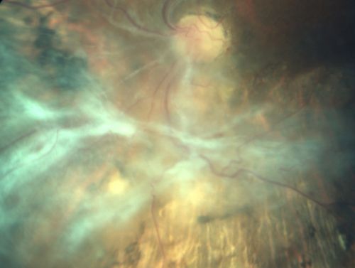 Chronic - Old Diabetic Tractional Retinal Detachment Left Eye
77-year-old woman Vision OD is 20/40, OS is 7/200OD:  Vertical C/D ratio is 0.3.  There is panretinal laser.  The macula is flat and attached.
OS:   Vertical C/D ratio is 0.3.  There is panretinal laser.  There is a tractional retinal detachment with preretinal fibrosis nasal to the optic nerves.


