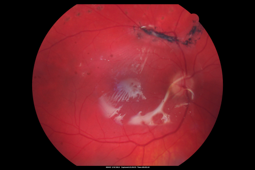Giant Retinal Diaylsis Retinal Detachment - Post-op 2 months vision reasonable under silicone oil - Retina Attached
2 months post-op with silicone oil in eye.
