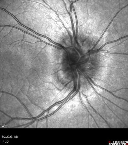 Disc drusen 8 year old boy - fluorescein shows no leakage
8 year old boy with headache and nausea.  He had a negative MRI. Images show hyper FAF from drusen and no leakage on FA.  No spinal tap was done.  VA was 20/40 both eyes.
