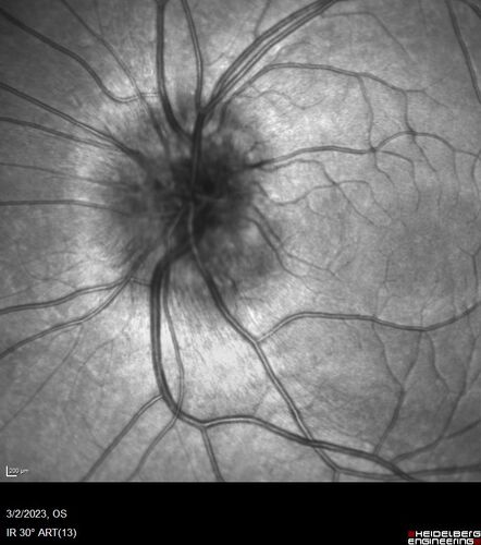 Disc drusen 8 year old boy - fluorescein shows no leakage
8 year old boy with headache and nausea.  He had a negative MRI. Images show hyper FAF from drusen and no leakage on FA.  No spinal tap was done.  VA was 20/40 both eyes.
