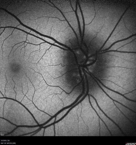 Disc drusen 8 year old boy - fluorescein shows no leakage
8 year old boy with headache and nausea.  He had a negative MRI. Images show hyper FAF from drusen and no leakage on FA.  No spinal tap was done.  VA was 20/40 both eyes.
