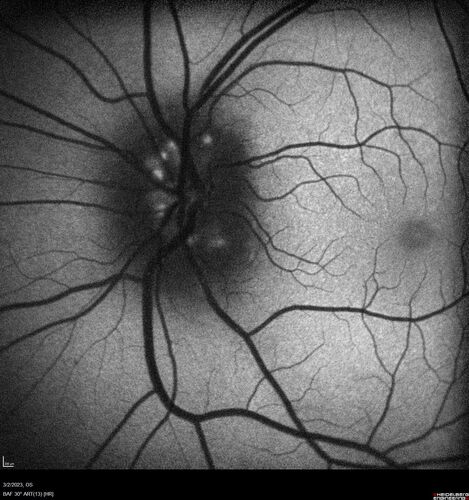 Disc drusen 8 year old boy - fluorescein shows no leakage
8 year old boy with headache and nausea.  He had a negative MRI. Images show hyper FAF from drusen and no leakage on FA.  No spinal tap was done.  VA was 20/40 both eyes.
