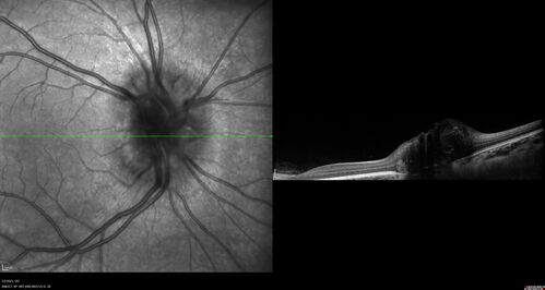 Disc drusen 8 year old boy - fluorescein shows no leakage
8 year old boy with headache and nausea.  He had a negative MRI. Images show hyper FAF from drusen and no leakage on FA.  No spinal tap was done.  VA was 20/40 both eyes.
