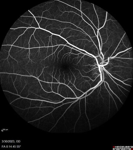 Disc drusen 8 year old boy - fluorescein shows no leakage
8 year old boy with headache and nausea.  He had a negative MRI. Images show hyper FAF from drusen and no leakage on FA.  No spinal tap was done.  VA was 20/40 both eyes.
