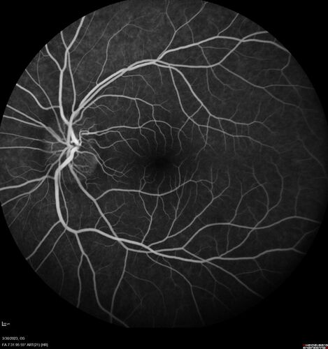 Disc drusen 8 year old boy - fluorescein shows no leakage
8 year old boy with headache and nausea.  He had a negative MRI. Images show hyper FAF from drusen and no leakage on FA.  No spinal tap was done.  VA was 20/40 both eyes.
