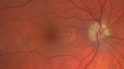 Optic Disc Drusen - Calcified
