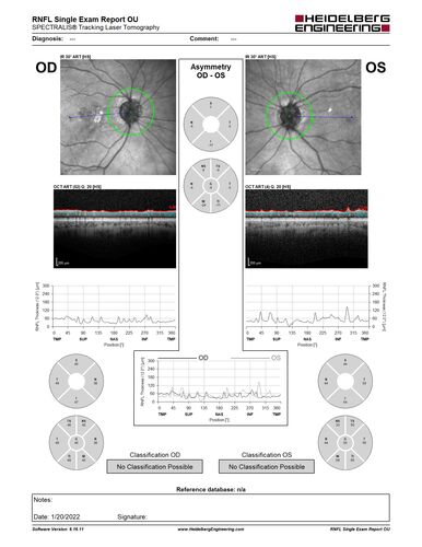 Optic Disc Drusen - Calcified
