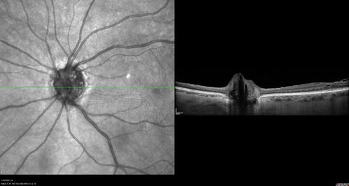 Optic Disc Drusen - Calcified
