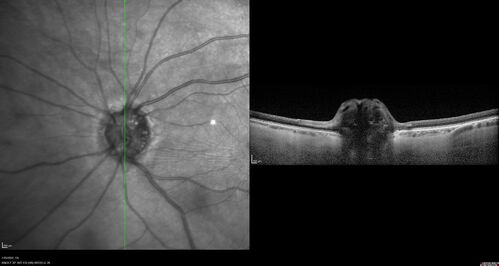 Optic Disc Drusen - Calcified

