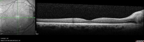 Papilledema following carotid endarterectomy - Cerebral Reperfusion Injury
77 year old man His vision has been a little fuzzy for the last few weeks.  He was examined by another eye doctor who was concerned about the optic nerves. The patient has also had double vision for 6 weeks which is improving
PMHx â€“ HTN, 
Surgery â€“ Carotic Endarterectomy 6 weeks ago (both sides)
VA 20/25 OD, 20/20 OS
