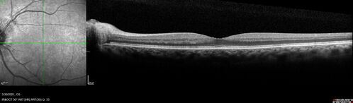 Papilledema following carotid endarterectomy - Cerebral Reperfusion Injury
77 year old man His vision has been a little fuzzy for the last few weeks.  He was examined by another eye doctor who was concerned about the optic nerves. The patient has also had double vision for 6 weeks which is improving
PMHx â€“ HTN, 
Surgery â€“ Carotic Endarterectomy 6 weeks ago (both sides)
VA 20/25 OD, 20/20 OS
