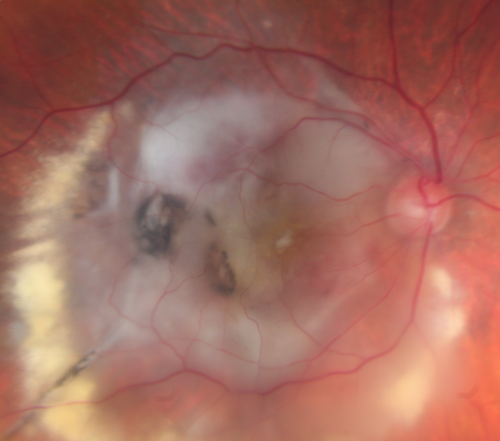 Disciform Macular Scar Both Eyes from Wet Macular Degeneration
86-year-old woman has disciform scars  OD:  20/400;  OS:   20/100
