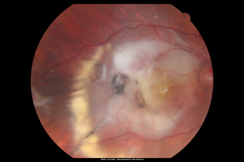 Disciform Macular Scar Both Eyes from Wet Macular Degeneration
86-year-old woman has disciform scars  OD:  20/400;  OS:   20/100
