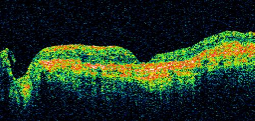 Disciform Macular Scar Both Eyes from Wet Macular Degeneration
86-year-old woman has disciform scars  OD:  20/400;  OS:   20/100
