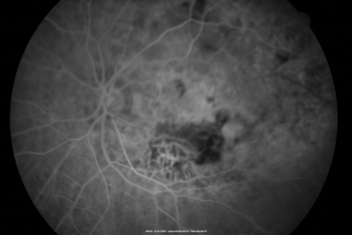 Disciform Macular Scar Both Eyes from Wet Macular Degeneration
86-year-old woman has disciform scars  OD:  20/400;  OS:   20/100
Keywords: Disciform Macular Scar Both Eyes from Wet Macular Degeneration