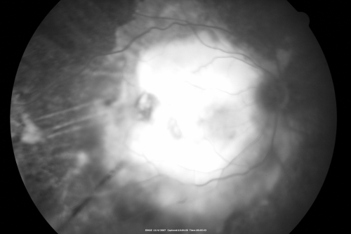 Disciform Macular Scar Both Eyes from Wet Macular Degeneration
86-year-old woman has disciform scars  OD:  20/400;  OS:   20/100
