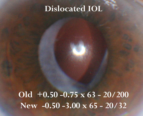 Dislocated IOL - Astigmastism - Corrected with new prescription
82 year old woman with prior vitrectomy for macular hole - vision dropped from 20/32 to 20/200.  Corrected with new rx: 11/2016 old RX OD +0.5 -0.75 x 63; new rx -0.50 -3.00 x 65
