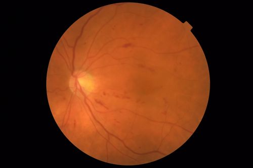 Diabetic Macular Edema - One eye treated with Eylea and 2 weeks later both were improved
68 year old female with diabetic retinopathy and macular edema   
VA OD: sc20/40 PH20/32
VA OS: sc20/40 PH20/32
IOP: TP: OD:14 OS:14 Time:12:45
