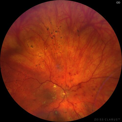 Siegrist Streaks and severe diabetic macular edema
56 year old female who presents four years after developing necrotizing fascitis and multiple organ failure from an infected foot from a roofing nail.  Her vision was 20/100 OU.  She has multiple peripheral pigment spots consistent with Siegrist streaks.
