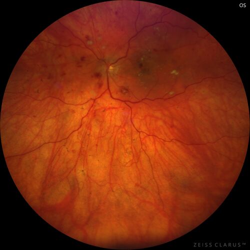 Siegrist Streaks and severe diabetic macular edema
56 year old female who presents four years after developing necrotizing fascitis and multiple organ failure from an infected foot from a roofing nail.  Her vision was 20/100 OU.  She has multiple peripheral pigment spots consistent with Siegrist streaks.
