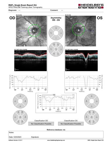 Siegrist Streaks and severe diabetic macular edema
56 year old female who presents four years after developing necrotizing fascitis and multiple organ failure from an infected foot from a roofing nail.  Her vision was 20/100 OU.  She has multiple peripheral pigment spots consistent with Siegrist streaks.
