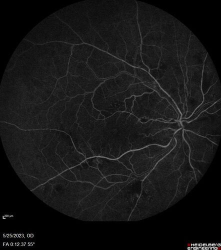 Siegrist Streaks and severe diabetic macular edema
56 year old female who presents four years after developing necrotizing fascitis and multiple organ failure from an infected foot from a roofing nail.  Her vision was 20/100 OU.  She has multiple peripheral pigment spots consistent with Siegrist streaks.
