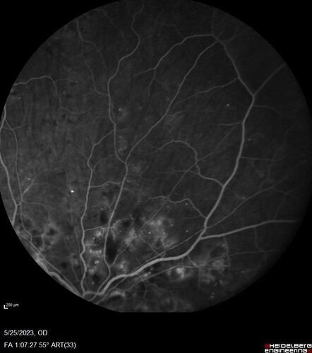 Siegrist Streaks and severe diabetic macular edema
56 year old female who presents four years after developing necrotizing fascitis and multiple organ failure from an infected foot from a roofing nail.  Her vision was 20/100 OU.  She has multiple peripheral pigment spots consistent with Siegrist streaks.
