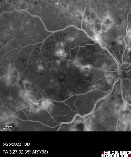 Siegrist Streaks and severe diabetic macular edema
56 year old female who presents four years after developing necrotizing fascitis and multiple organ failure from an infected foot from a roofing nail.  Her vision was 20/100 OU.  She has multiple peripheral pigment spots consistent with Siegrist streaks.
