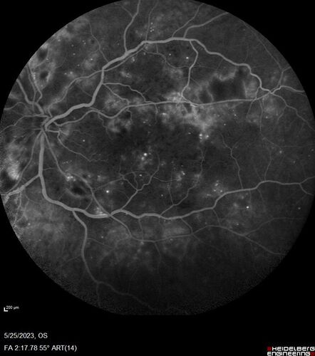 Siegrist Streaks and severe diabetic macular edema
56 year old female who presents four years after developing necrotizing fascitis and multiple organ failure from an infected foot from a roofing nail.  Her vision was 20/100 OU.  She has multiple peripheral pigment spots consistent with Siegrist streaks.
