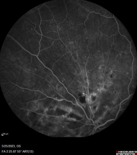 Siegrist Streaks and severe diabetic macular edema
56 year old female who presents four years after developing necrotizing fascitis and multiple organ failure from an infected foot from a roofing nail.  Her vision was 20/100 OU.  She has multiple peripheral pigment spots consistent with Siegrist streaks.
