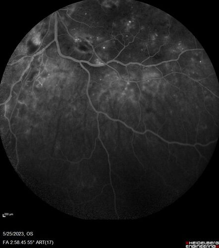 Siegrist Streaks and severe diabetic macular edema
56 year old female who presents four years after developing necrotizing fascitis and multiple organ failure from an infected foot from a roofing nail.  Her vision was 20/100 OU.  She has multiple peripheral pigment spots consistent with Siegrist streaks.
