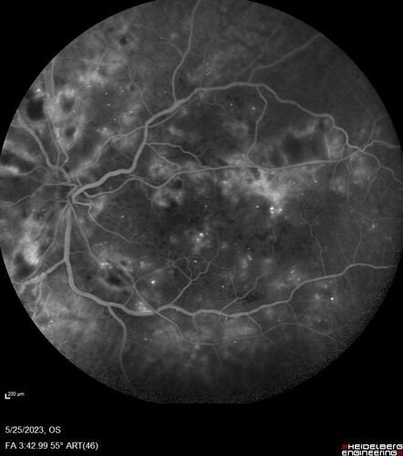Siegrist Streaks and severe diabetic macular edema
56 year old female who presents four years after developing necrotizing fascitis and multiple organ failure from an infected foot from a roofing nail.  Her vision was 20/100 OU.  She has multiple peripheral pigment spots consistent with Siegrist streaks.
