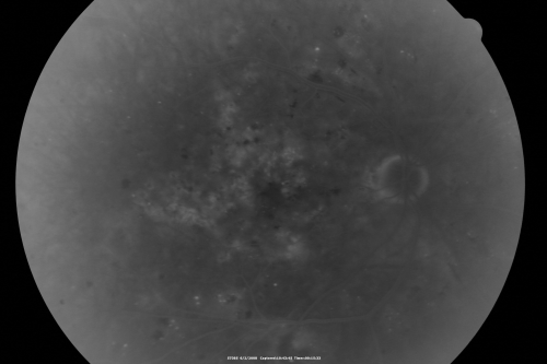 BDR and Diabetic Macular Edema with Fresh Laser Right Eye
60-year old man OD 20/60, OS 20/50 worsening vision both eyes
