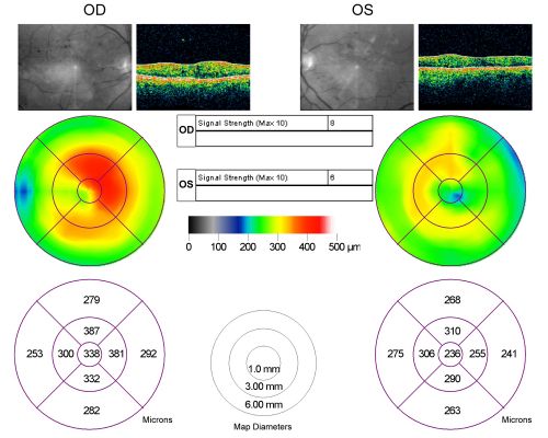BDR and Diabetic Macular Edema with Fresh Laser Right Eye
60-year old man OD 20/60, OS 20/50 worsening vision both eyes
