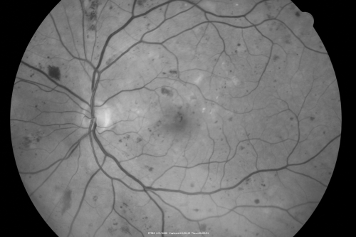 BDR and Diabetic Macular Edema with Fresh Laser Right Eye
60-year old man OD 20/60, OS 20/50 worsening vision both eyes
