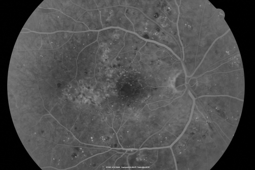 BDR and Diabetic Macular Edema with Fresh Laser Right Eye
60-year old man OD 20/60, OS 20/50 worsening vision both eyes
