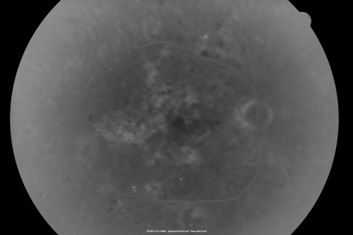 BDR and Diabetic Macular Edema with Fresh Laser Right Eye
60-year old man OD 20/60, OS 20/50 worsening vision both eyes
