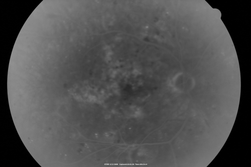 BDR and Diabetic Macular Edema with Fresh Laser Right Eye
60-year old man OD 20/60, OS 20/50 worsening vision both eyes

