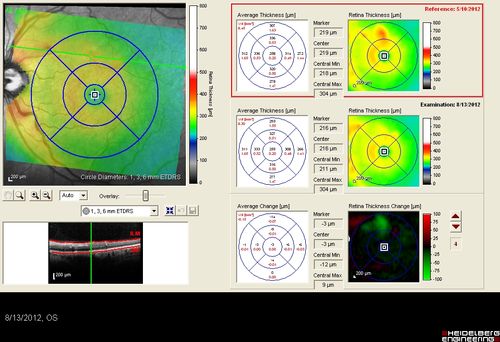 Diabetic Macular Edema - Mild
70 year old man with mild edema did well without treatment
