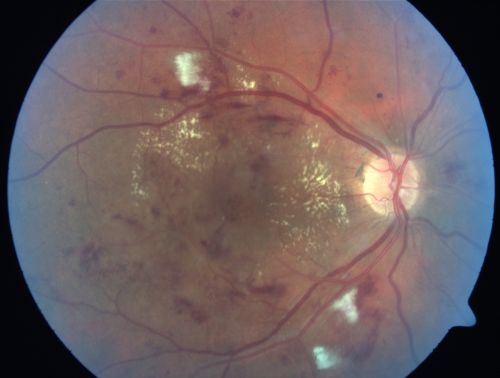 Diabetic Patient with Macular Edema and Blood Pressure 200/95
49-year-old decreasing vision over the last year. OD is 20/80, OS 20/80.   blood pressure which was 200/95.

Keywords: macular edema;cotton wool spots;diabetic;hypertensive