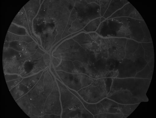 Diabetic Patient with Macular Edema and Blood Pressure 200/95
49-year-old decreasing vision over the last year. OD is 20/80, OS 20/80.   blood pressure which was 200/95.

Keywords: macular edema;cotton wool spots;diabetic;hypertensive