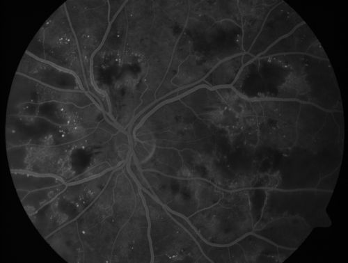 Diabetic Patient with Macular Edema and Blood Pressure 200/95
49-year-old decreasing vision over the last year. OD is 20/80, OS 20/80.   blood pressure which was 200/95.

Keywords: macular edema;cotton wool spots;diabetic;hypertensive
