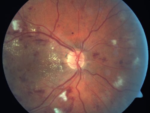 Diabetic Patient with Macular Edema and Blood Pressure 200/95
49-year-old decreasing vision over the last year. OD is 20/80, OS 20/80.   blood pressure which was 200/95.

Keywords: macular edema;cotton wool spots;diabetic;hypertensive