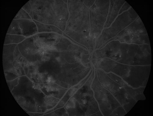 Diabetic Patient with Macular Edema and Blood Pressure 200/95
49-year-old decreasing vision over the last year. OD is 20/80, OS 20/80.   blood pressure which was 200/95.

Mots-clés: macular edema;cotton wool spots;diabetic;hypertensive