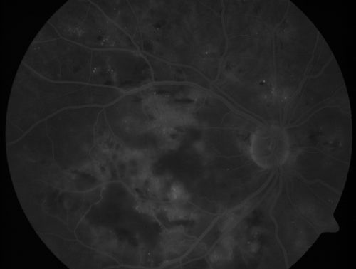 Diabetic Patient with Macular Edema and Blood Pressure 200/95
49-year-old decreasing vision over the last year. OD is 20/80, OS 20/80.   blood pressure which was 200/95.

Keywords: macular edema;cotton wool spots;diabetic;hypertensive